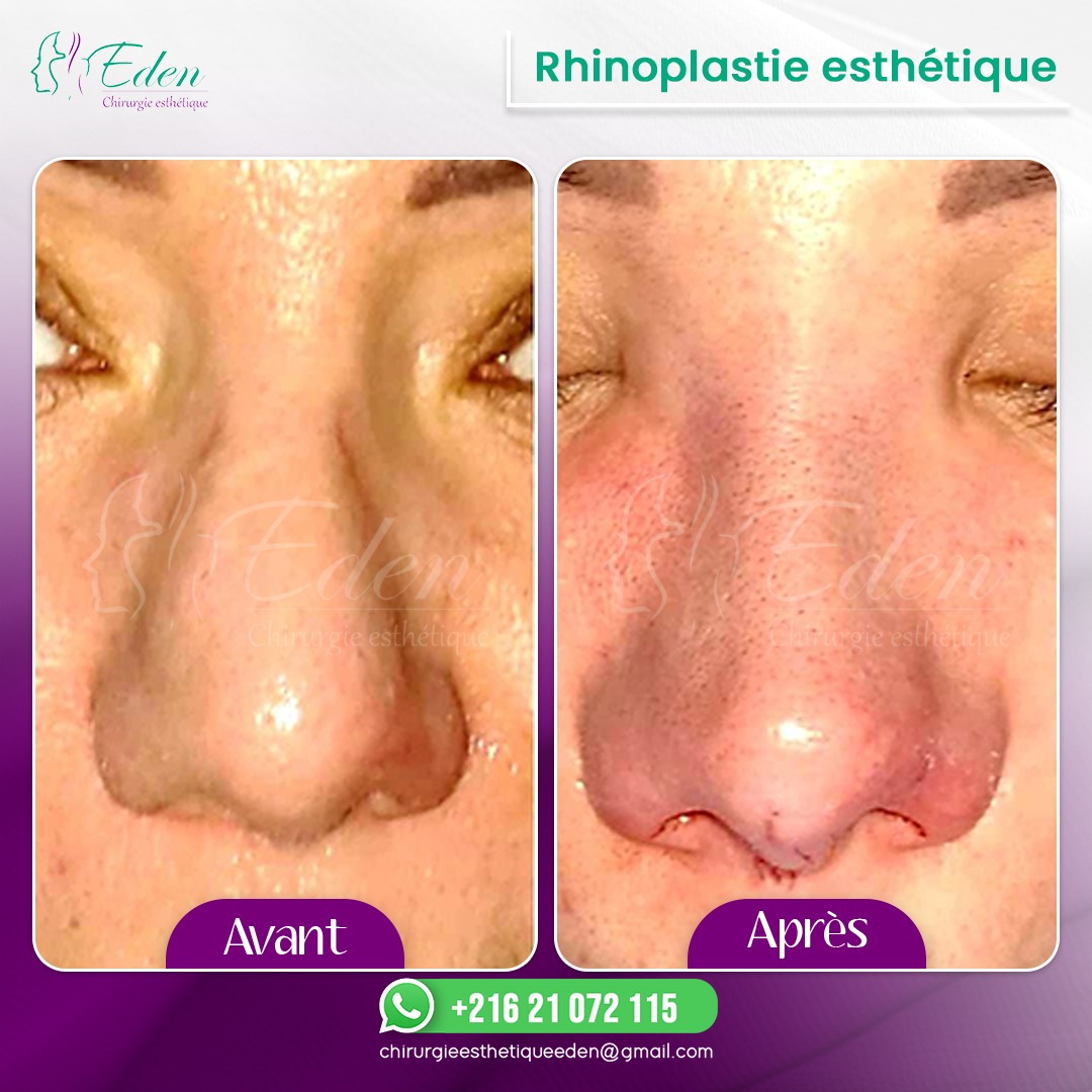 Rhinoplastie Tunisie prix pas cher Eden Chirurgie Esthétique