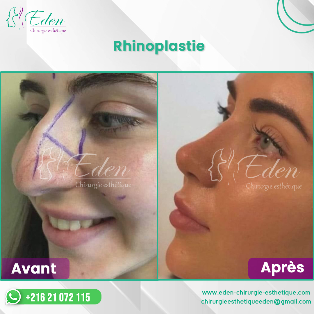 Rhinoplastie Tunisie prix pas cher Eden Chirurgie Esthétique