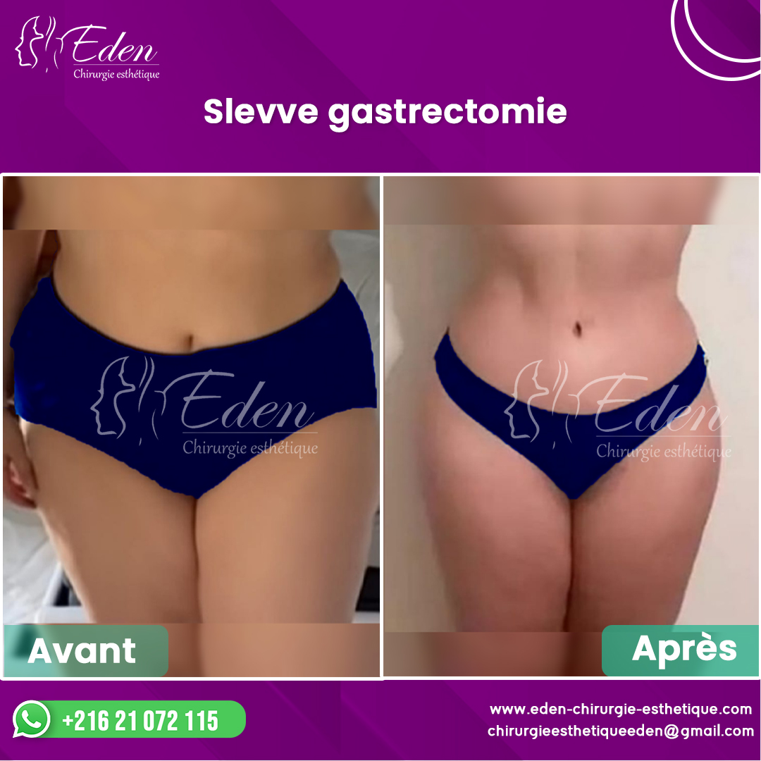 Sleeve gastrique Tunisie à bas prix Chirurgie de l obésité