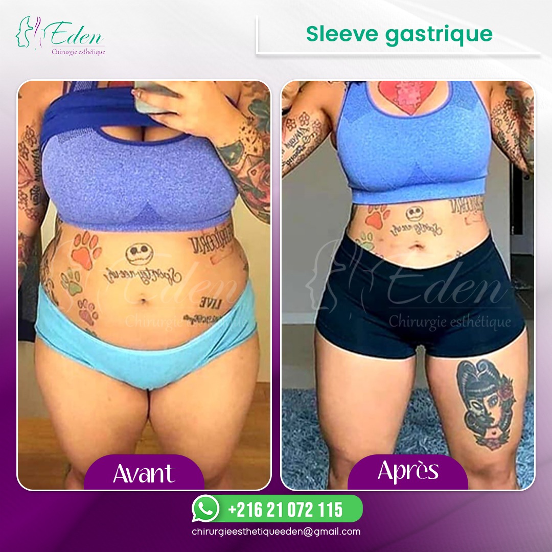 Sleeve Gastrique Tunisie Bas Prix Chirurgie De L Ob Sit