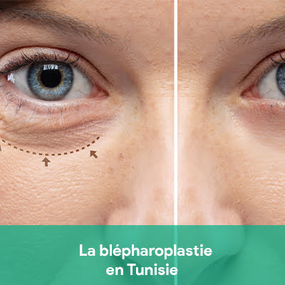 blépharoplastie tunisie