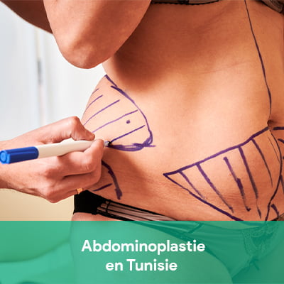 abdominoplastie Tunisie