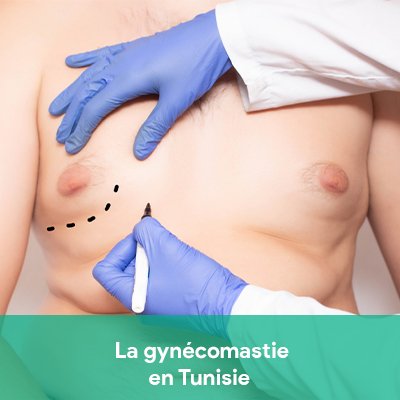 gynécomastie Tunisie
