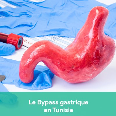 bypass gastrique tunisie