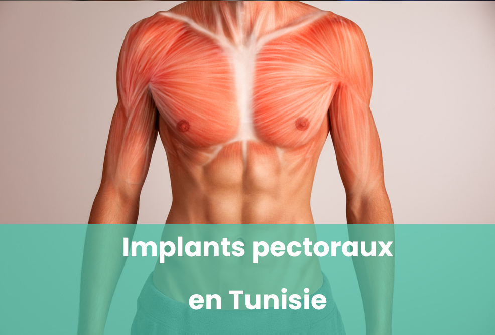 implants pectoraux