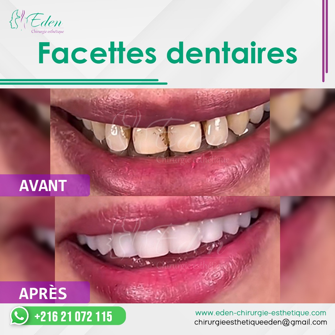 Facette dentaire Tunisie à bas prix Pose facette dentaire