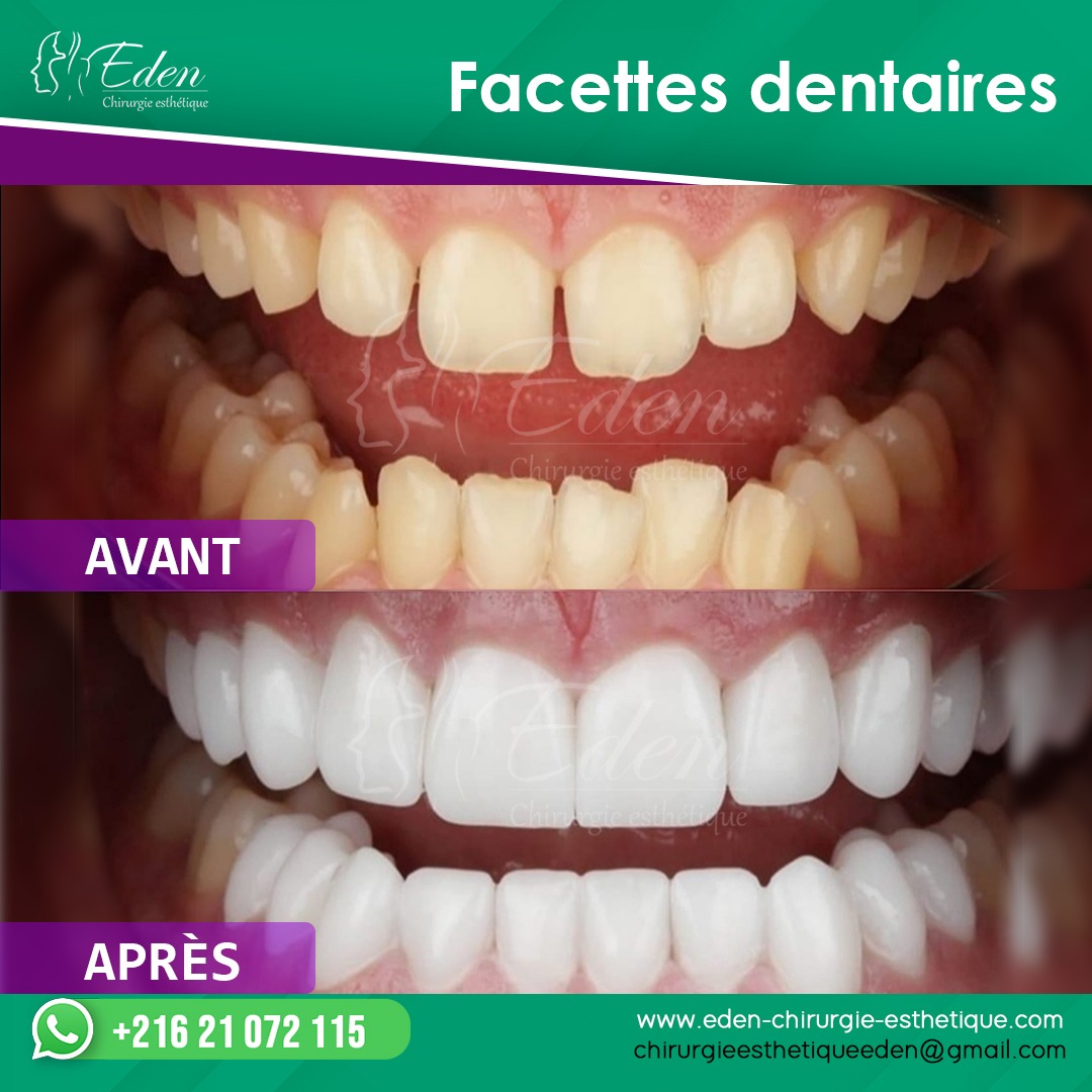 Facettes Dentaires à Clipser Cosmétiques - Prothèses Confortables - Neuves (générique)