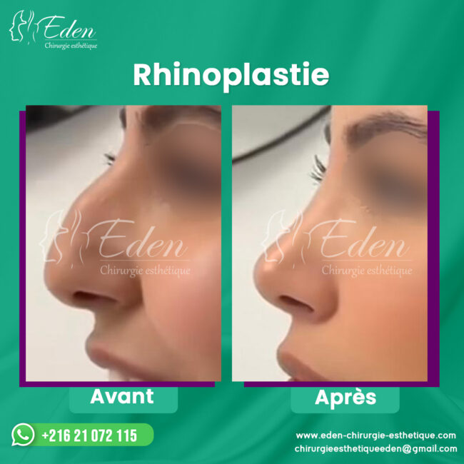 La Rhinoplastie en Tunisie à Bas Prix Abordable