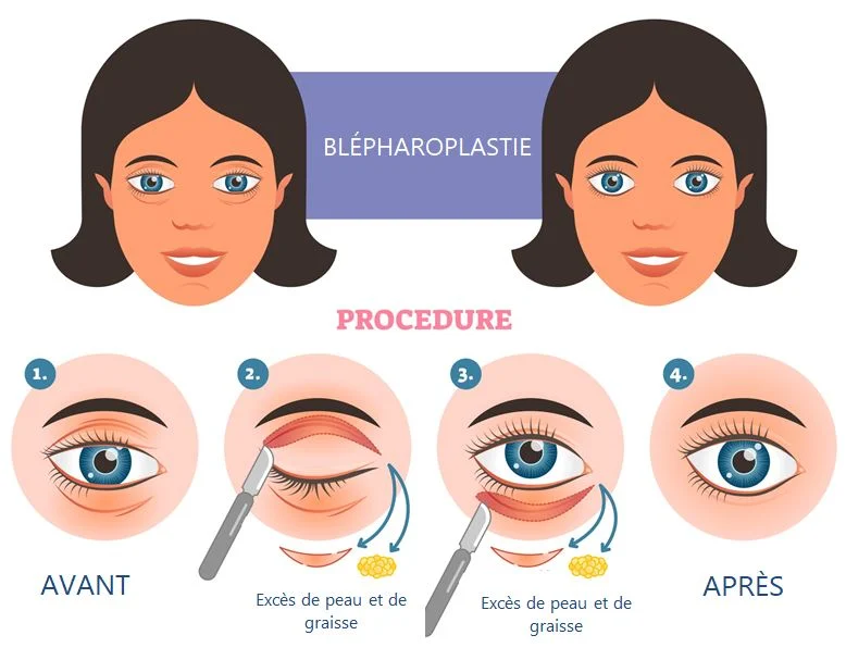 chirurgie des paupières en Tunisie