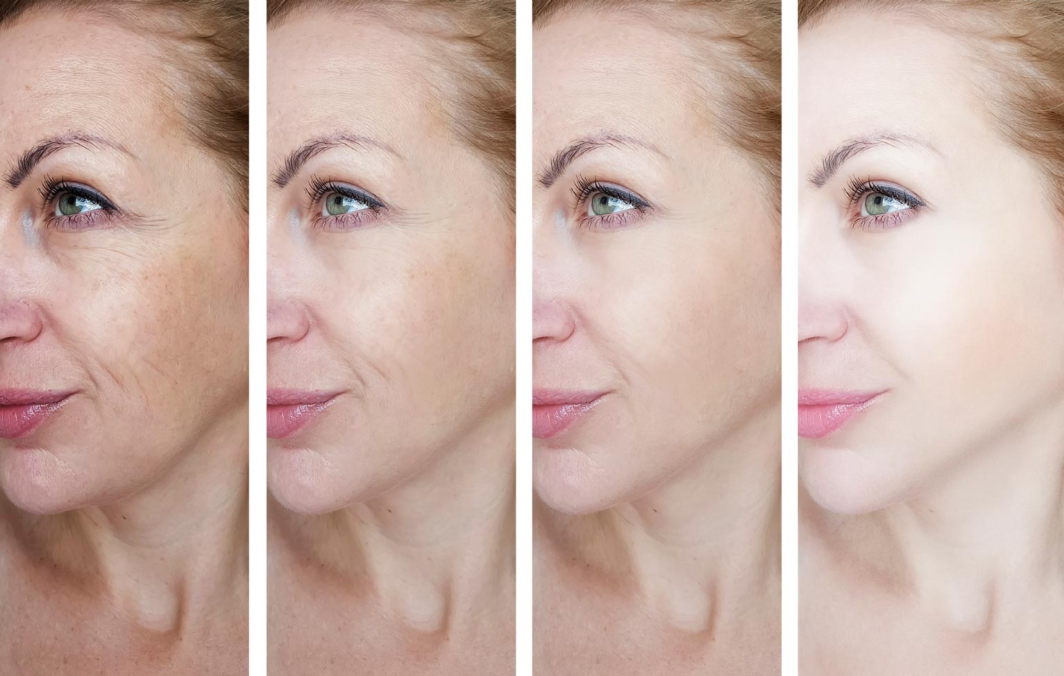 Chirurgie Esthétique du Visage botox vs lifting