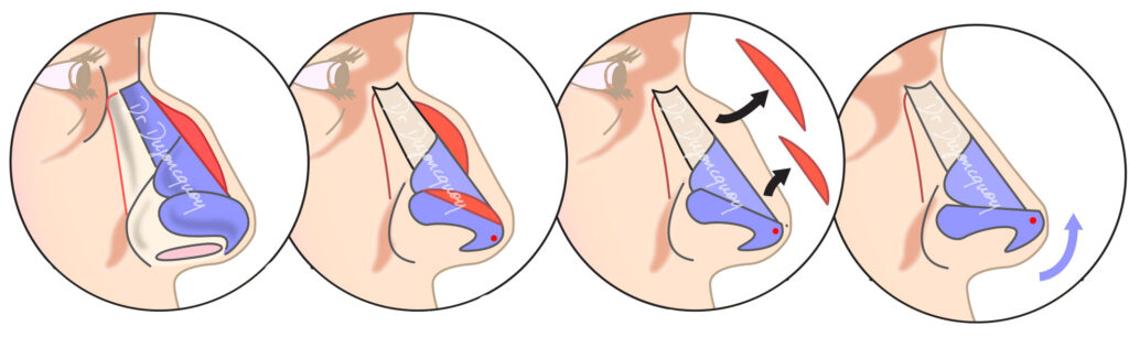 Chirurgie du Nez en Tunisie