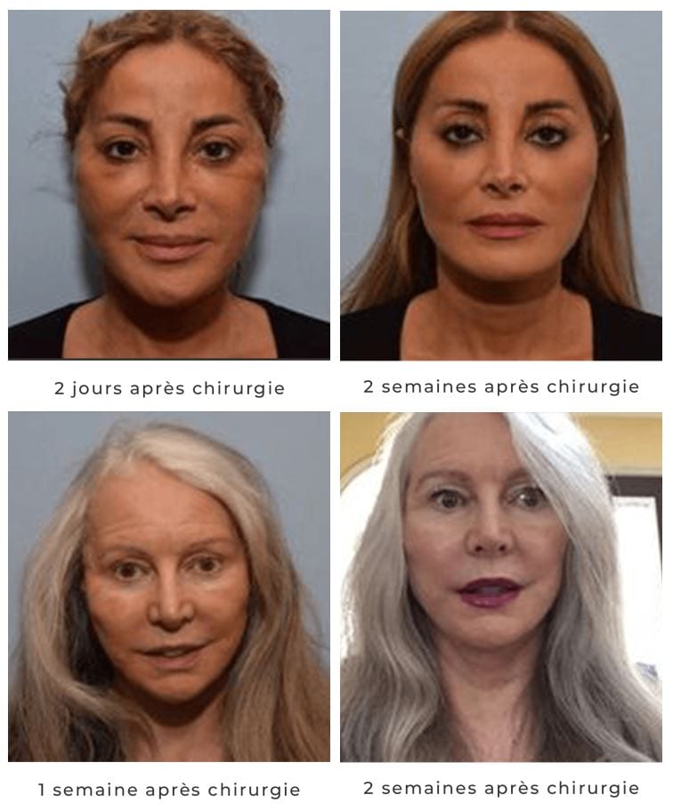 Chirurgie Esthétique du Visage