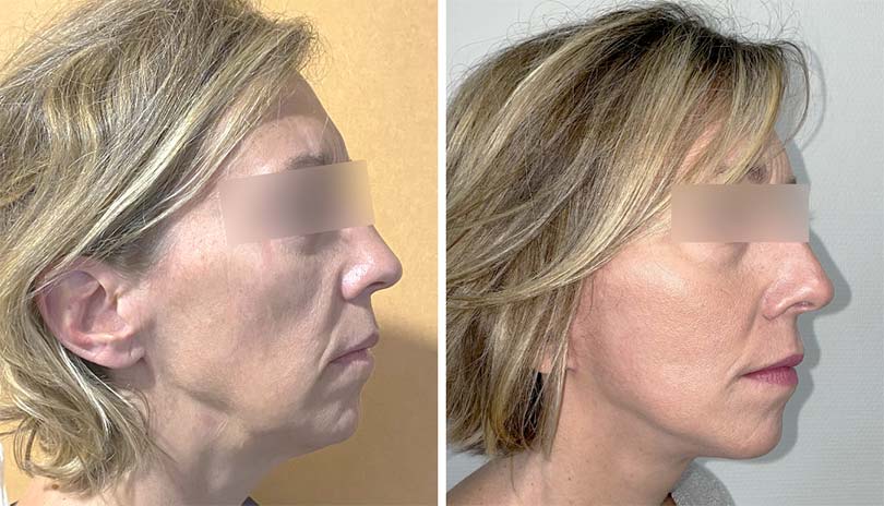 Chirurgie Esthétique du Visage